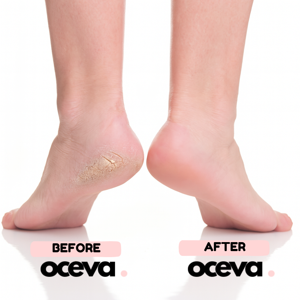 Oceva™ Electric Foot Callus Remover