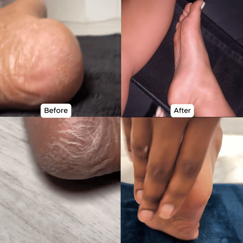 Oceva™ Electric Foot Callus Remover